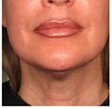 After Ultracel neck treatment
