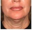 Before Ultracel neck treatment